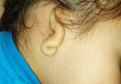 Help my kid to have new ear & ear canal