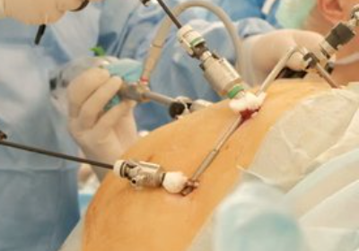 Urgent fundraising for sleeve operation