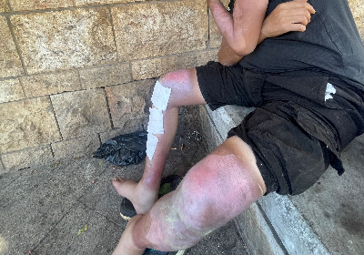 Securing a safe place for treating a burn victim