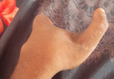 To borrow an artificial arm